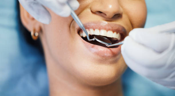 Best Emergency Wisdom Tooth Extraction in Mount Vernon, IL