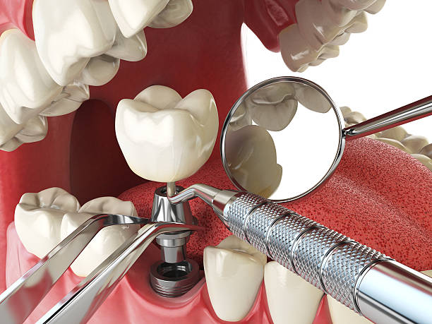 Best Broken or Chipped Tooth Repair in Mount Vernon, IL