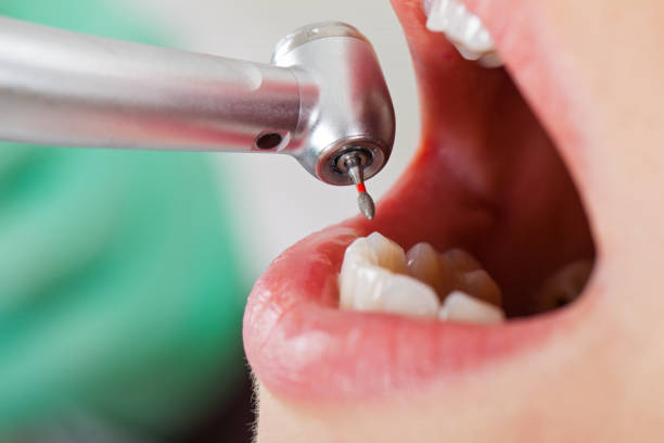 Best Knocked-Out Tooth (Avulsed Tooth) Treatment in Mount Vernon, IL
